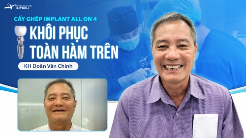 Trồng răng implant toàn hàm All on 4 có đau không?