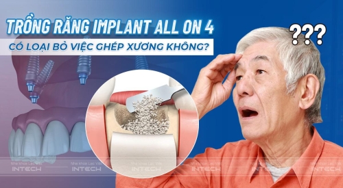 Trồng răng implant All-on-4 loại bỏ ghép xương không?