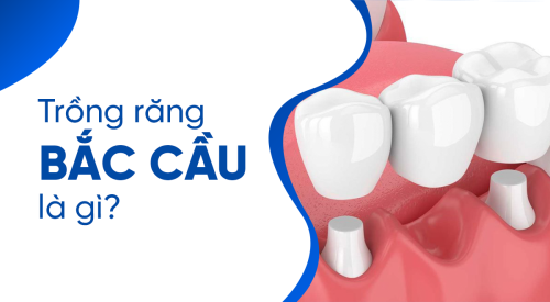 trồng răng bắc cầu