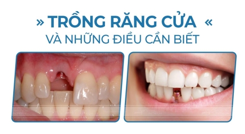 trồng răng cửa