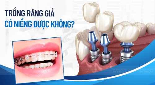 trồng răng giả có niềng được không