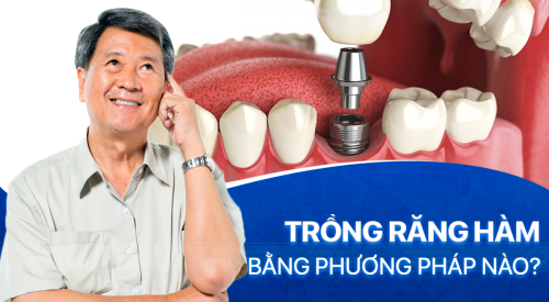 trồng răng hàm