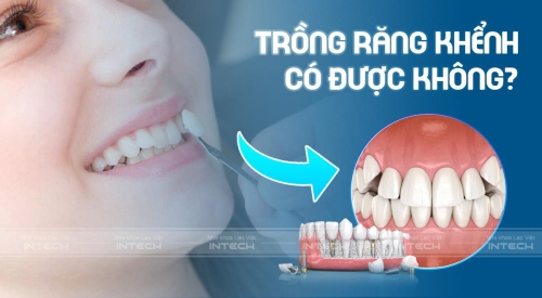 Trồng răng khểnh được không? Giá bao nhiêu tiền hiện nay?