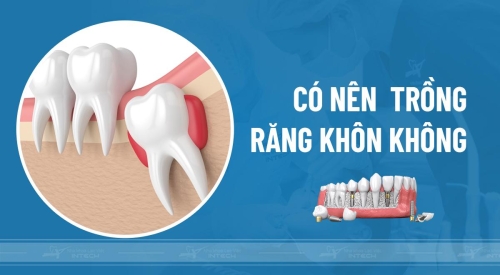 trồng răng khôn