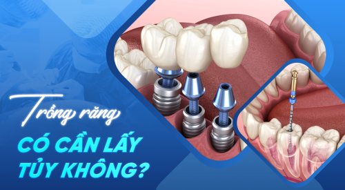 Trồng răng lấy tủy không? Giải pháp trồng răng không cần lấy tủy