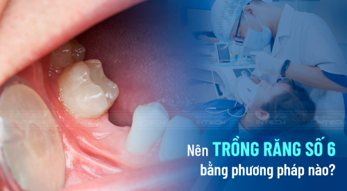 Nên trồng răng số 6 bằng phương pháp nào? Biến chứng mất răng số 6?