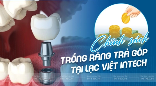 Trồng răng trả góp giá bao nhiêu? Chính sách trả góp tại Lạc Việt Intech
