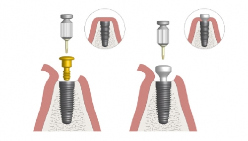 Healing Implant là gì? Vai trò và phân loại trụ lành thương