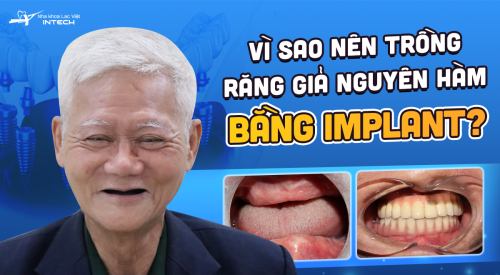 Vì sao nên trồng răng giả nguyên hàm bằng Implant? Trường hợp nên trồng nguyên ham