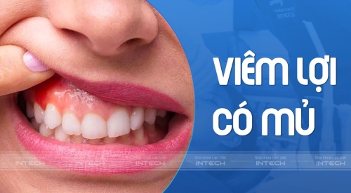 viêm lợi có mủ