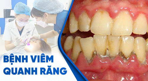 Cảnh báo: Viêm quanh răng và những biến chứng nguy hiểm