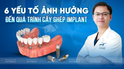 Bật mí 6 yếu tố ảnh hưởng đến cấy ghép implant rất quan trọng