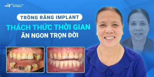 TRỒNG RĂNG IMPLANT – THÁCH THỨC THỜI GIAN, ĂN NGON TRỌN ĐỜI