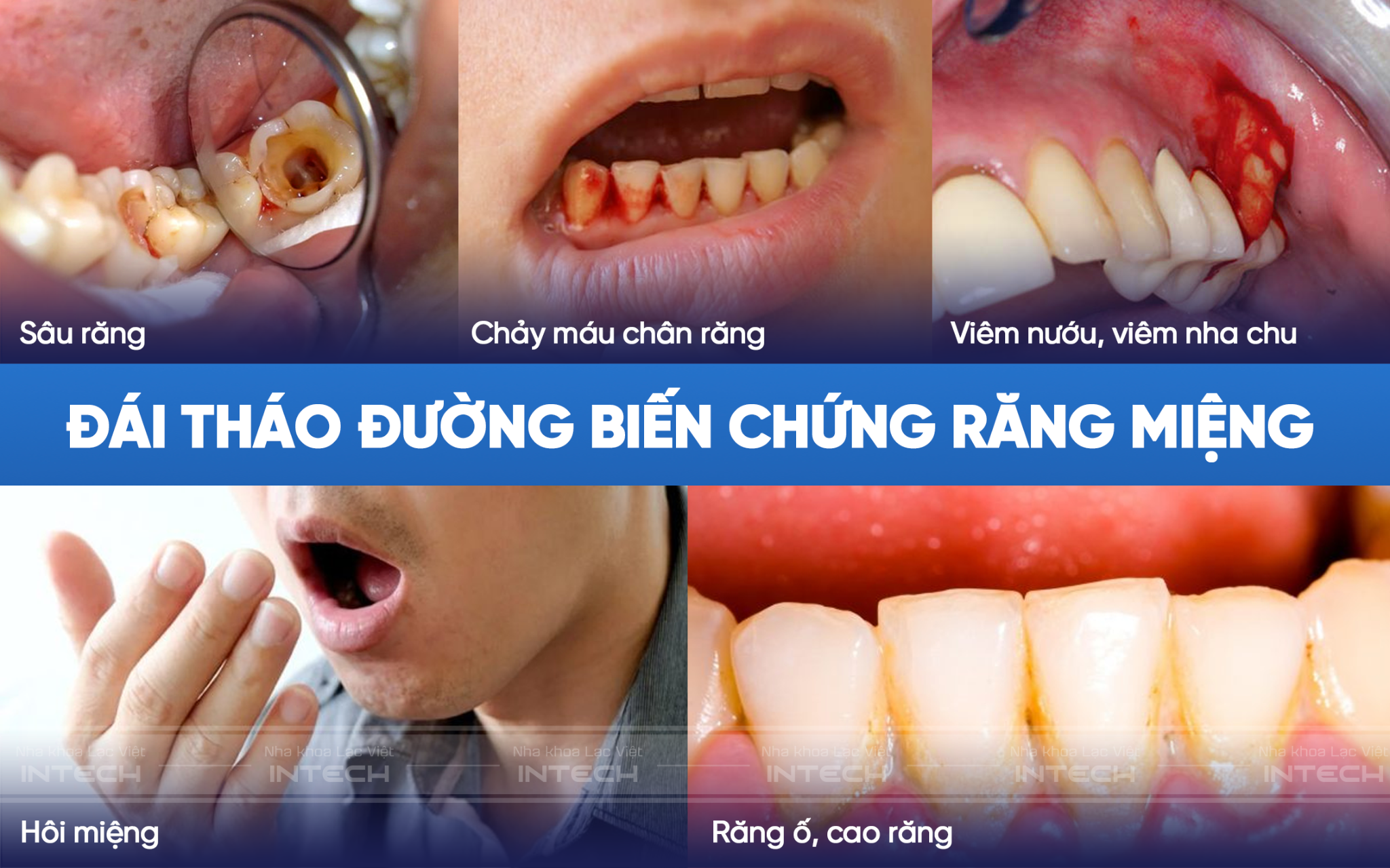 Bệnh tiểu đường gây ra các bệnh lý về răng miệng