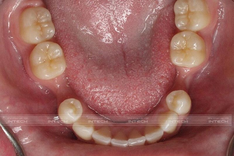 Tiêu xương hàm theo chiều ngang, xương hàm bị thu hẹp lại