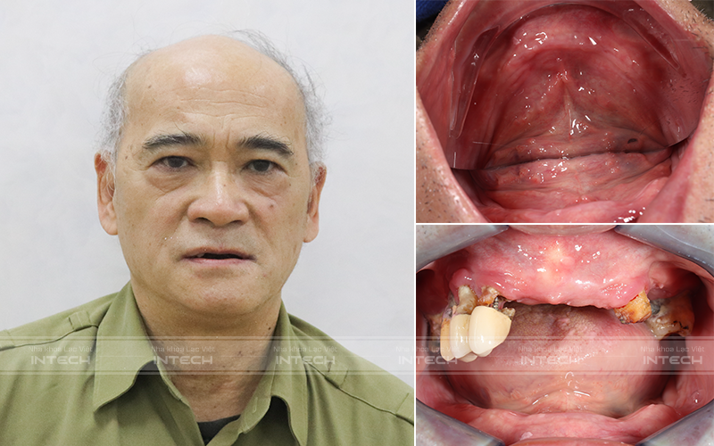 Tình trạng mất răng toàn hàm của khách hàng Vũ Hòa Bình