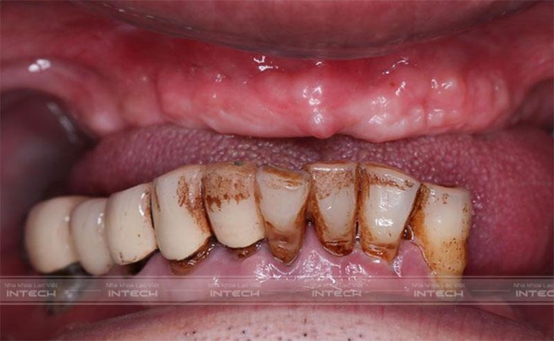 Tình trạng răng trước đây của chú Chu Văn Bảy