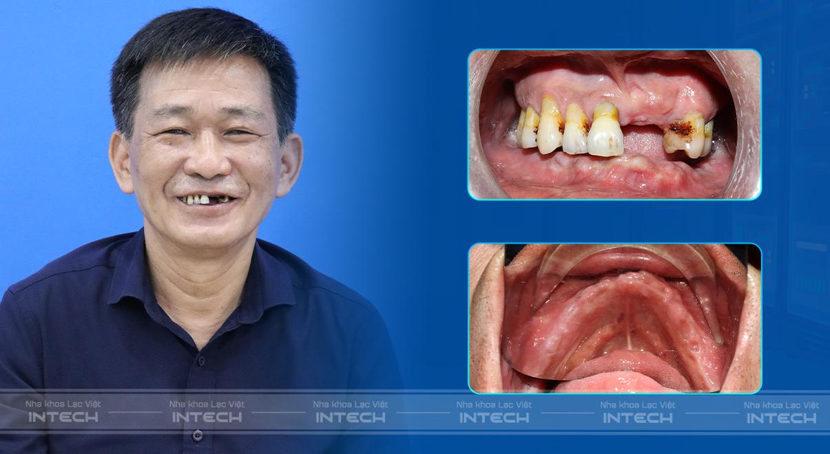 Tình trạng răng trước đây của chú Quản Văn Nghiệp