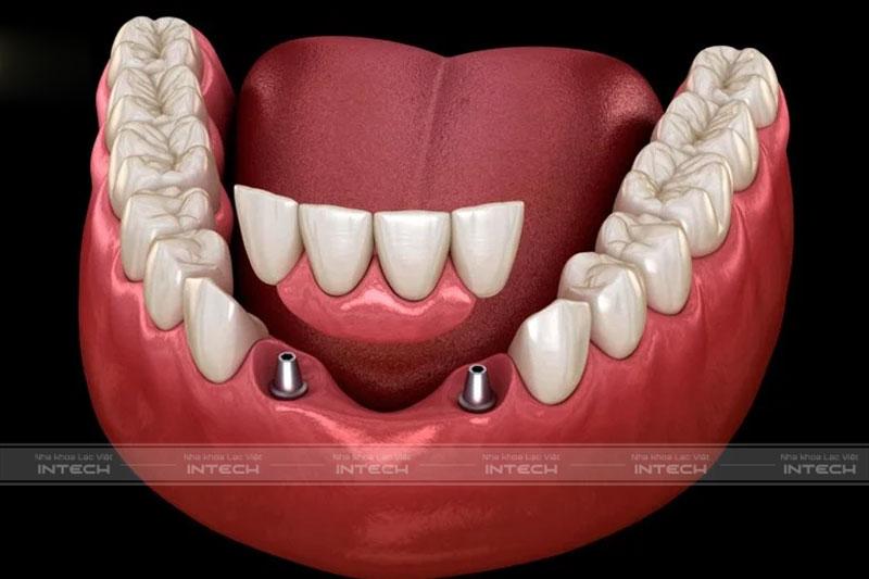 Trồng răng bắc cầu chỉ cần khôi phục tại vị trí răng mất, không xâm lấn răng bên cạnh