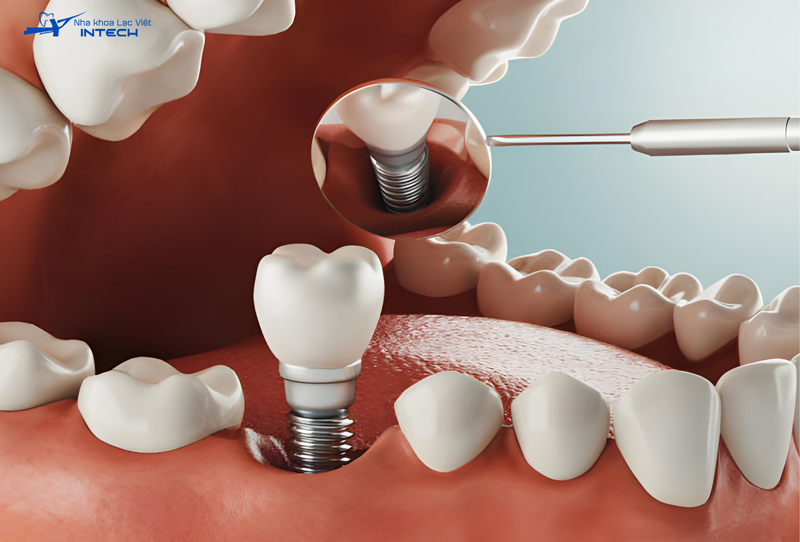 Cắm Implant ở vị trí răng cấm có chi phí tùy vào tình trạng răng và vật liệu khách hàng lựa chọn