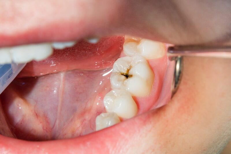 Chi phí trồng răng hàm bị sâu sẽ phụ thuộc vào các yếu tố trên, nhưng sẽ có sự thay đổi tùy vào mức độ phức tạp và yêu cầu điều trị  