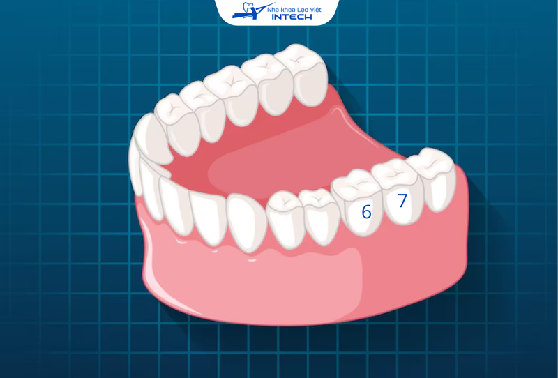 Răng cấm là răng hàm số 6, số 7