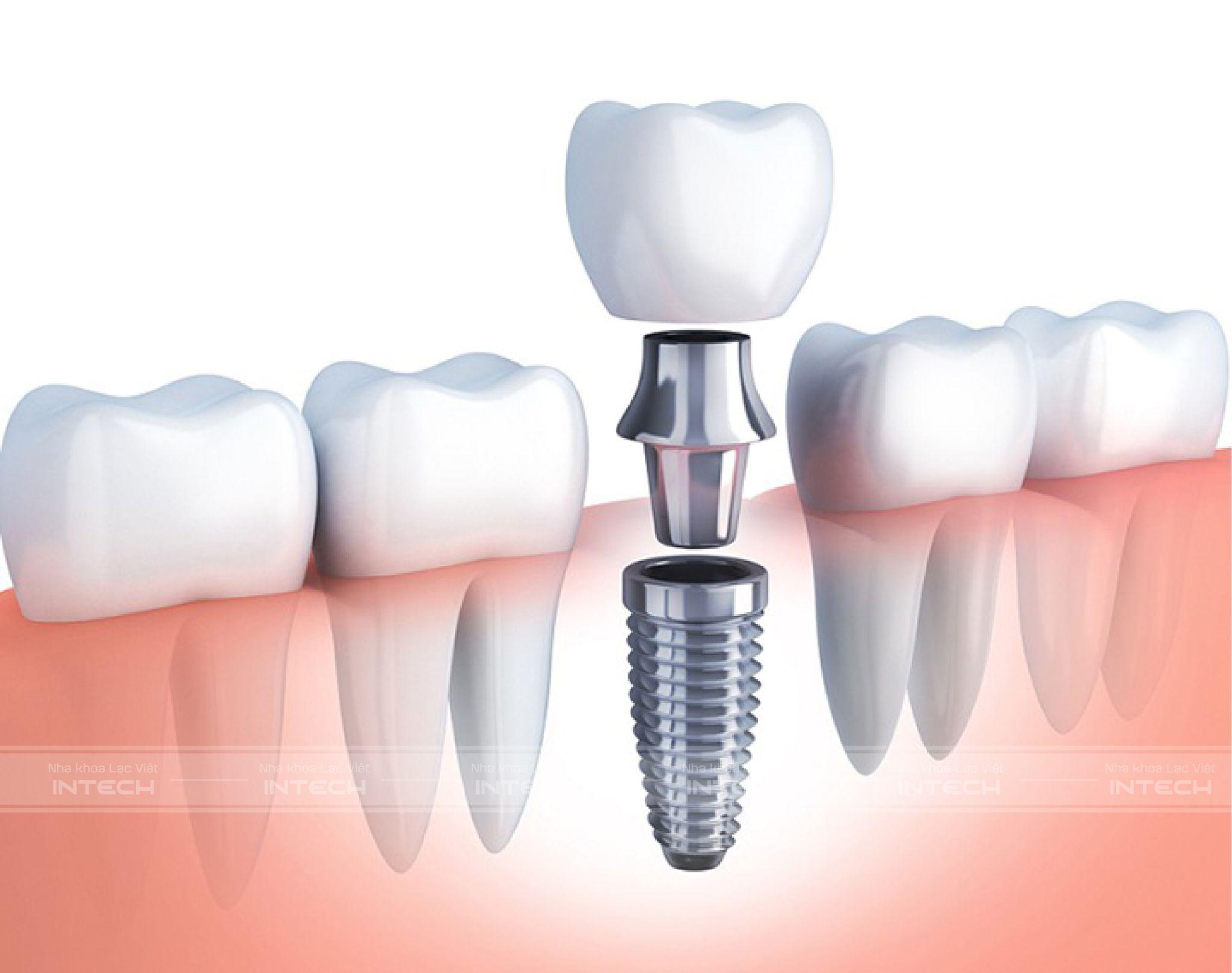 Trồng răng giả không gây ảnh hưởng tới sức khỏe nhờ khả năng tương thích tuyệt đối