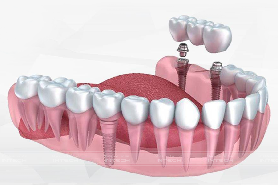 Trồng răng giả bằng ấy ghép Implant