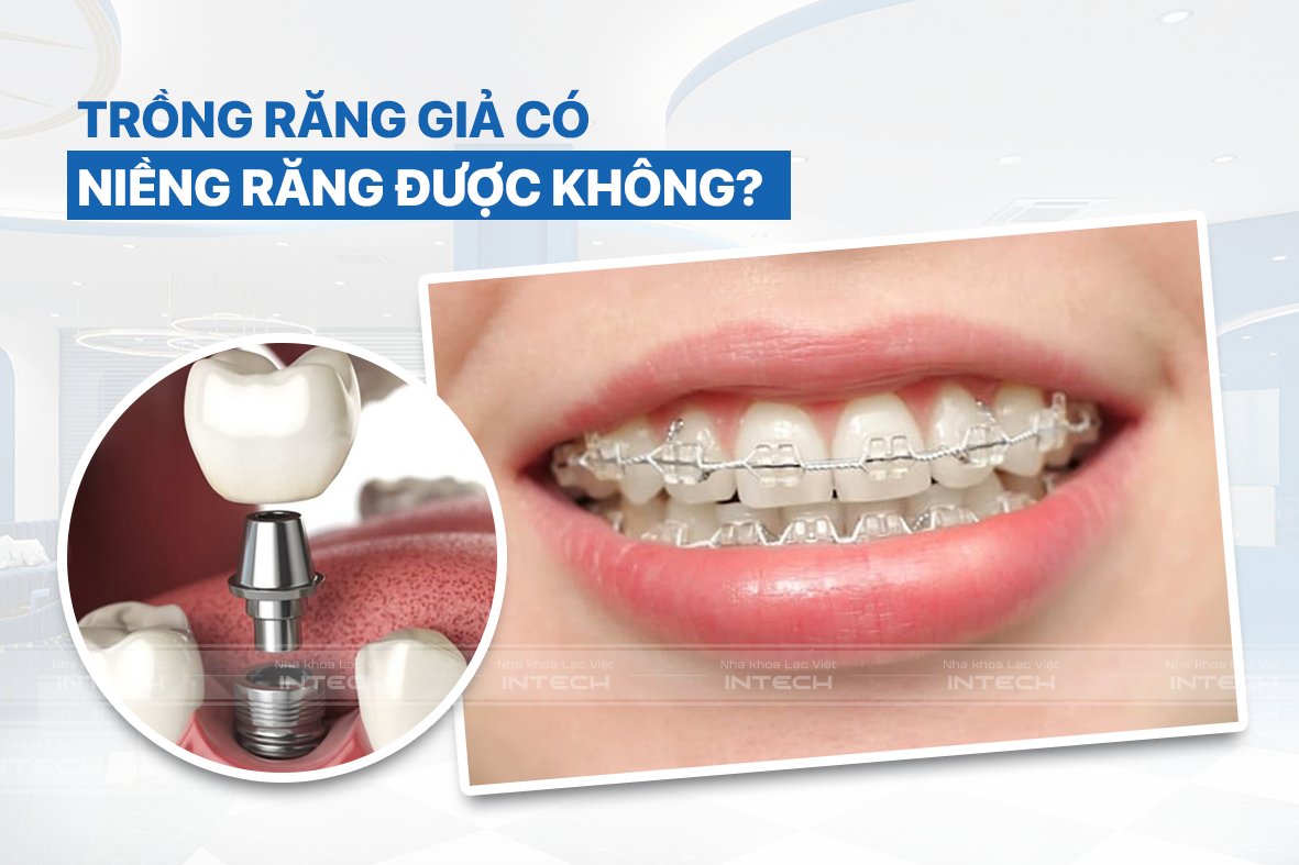 Trồng răng giả có niềng răng được hay không còn tùy vào từng trường hợp