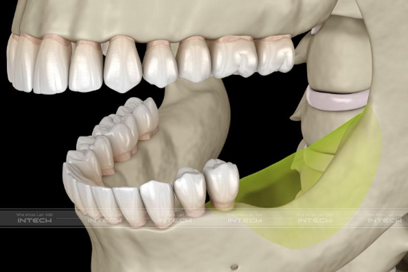 Việc trồng răng sớm sẽ ngăn chặn tình trạng tiêu xương hàm