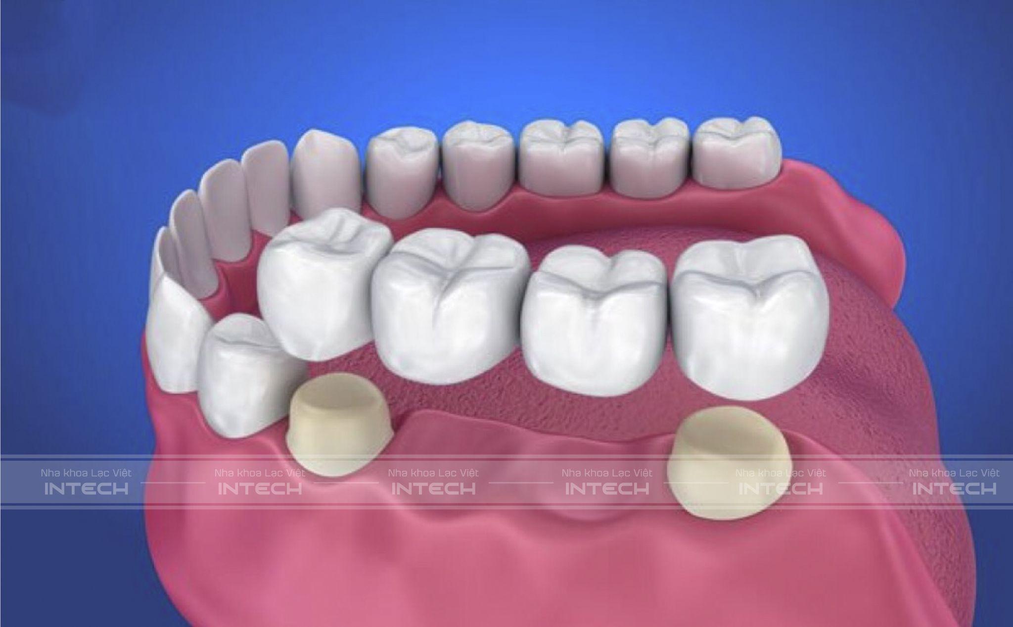 Trồng răng hàm bằng bắc cầu răng sứ