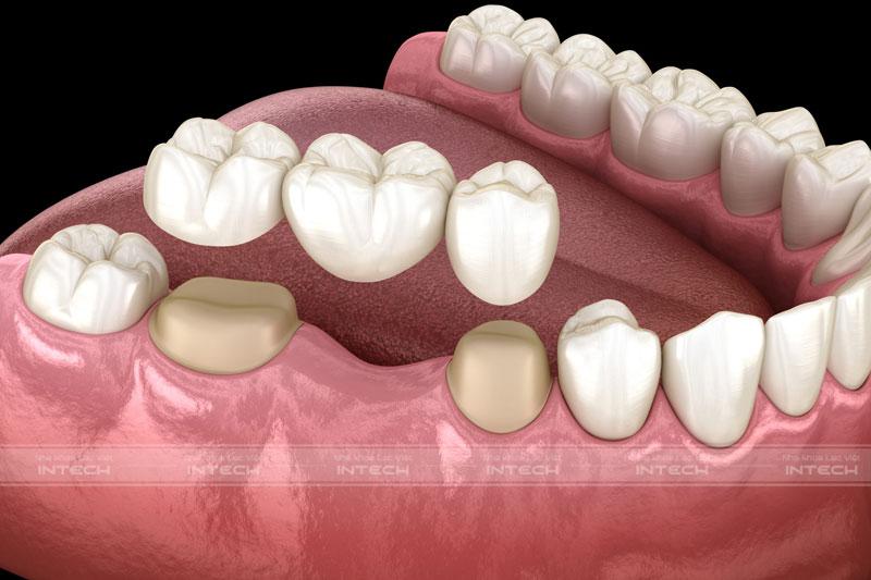 Trồng răng hàm bằng cầu sứ