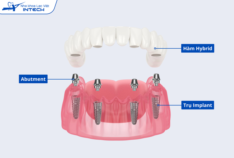 All-On-4 thường được ứng dụng ở hàm dưới do xương hàm đủ điều kiện