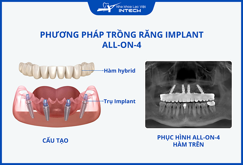 Cấu tạo All-On-4 gồm 4 trụ Implant, trụ phục hình và hàm Hybrid bên trên