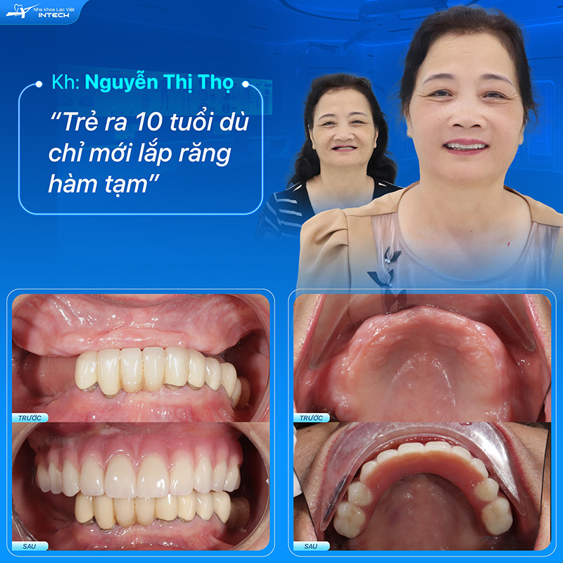 Sau khi cắm Implant, bác sĩ sẽ gắn hàm tạm để cô chú/anh chị ăn nhai tạm thời