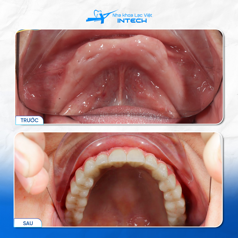 Sau khi trụ Implant tích hợp hoàn toàn, bác sĩ sẽ lắp hàm giả cố định lên trụ Implant và hoàn tất quá trình điều trị