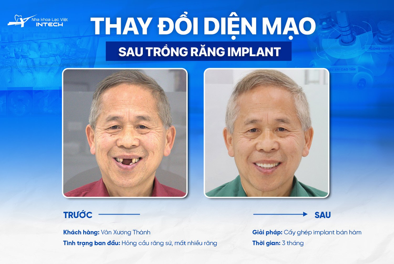 Trồng Implant All-On-4 hàm cố định được ưa chuộng vì khôi phục gần giống với răng thật nhất