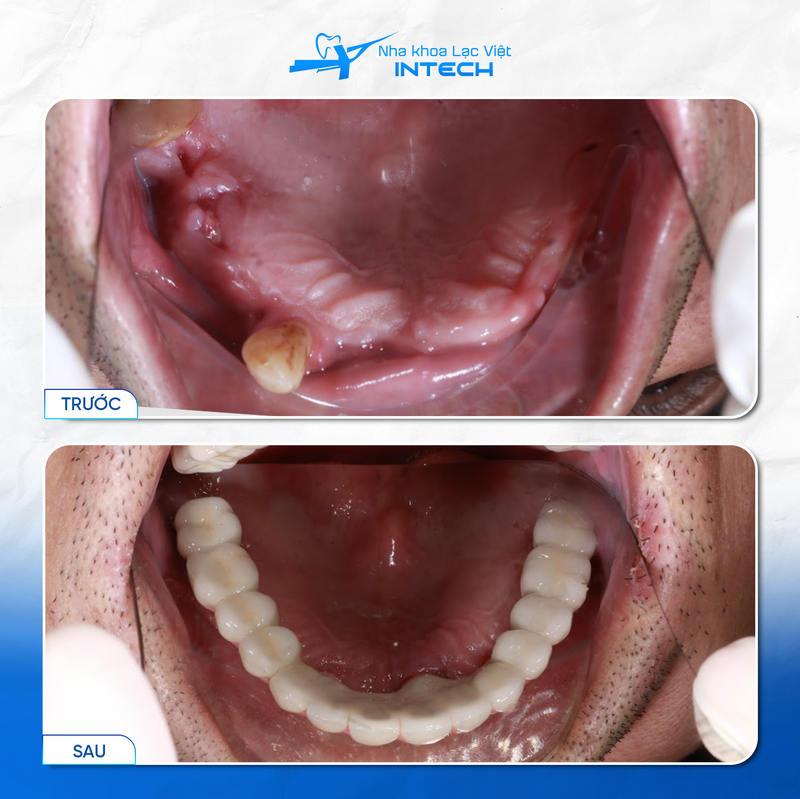 Trồng Implant All-On-4 phù hợp với người mất răng toàn hàm trên, hàm dưới hoặc cả hai hàm