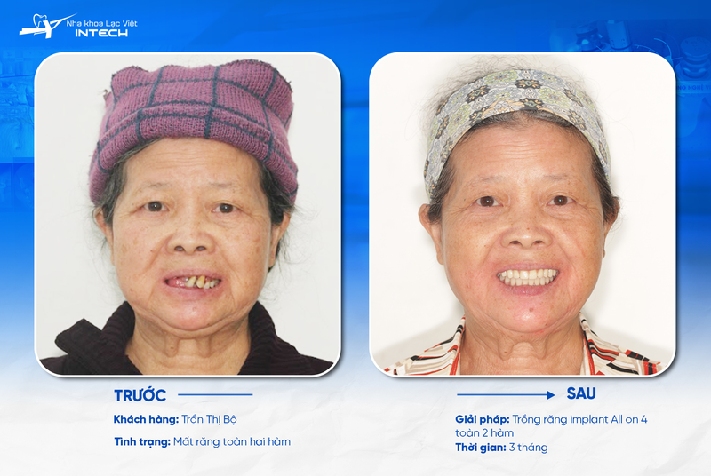 Trồng răng All-On-4 đáp ứng tốt những trường hợp mất răng lâu năm, mất toàn hàm, răng lỏng lẻo, xô lệch