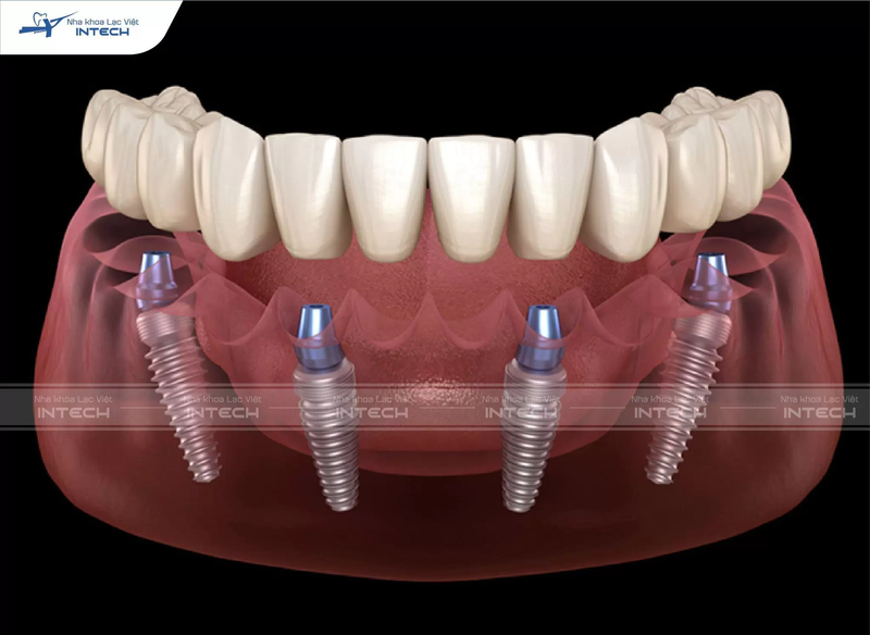 Trồng răng All-On-4 sử dụng 4 trụ Implant, trong đó có 2 trụ cắm nghiêng để tối ưu khả năng chịu lực