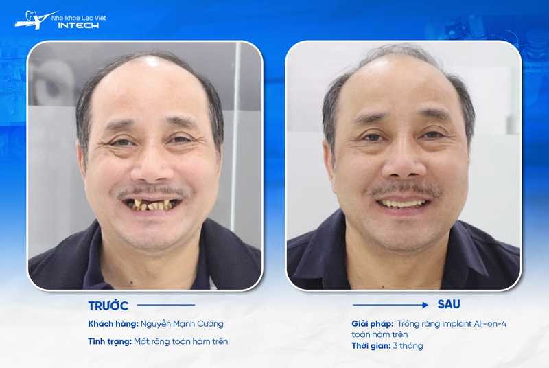 Trồng răng Implant All-On-4 giúp tiết kiệm chi phí tối ưu hơn mà vẫn đảm bảo độ bền, khả năng ăn nhai và thẩm mỹ