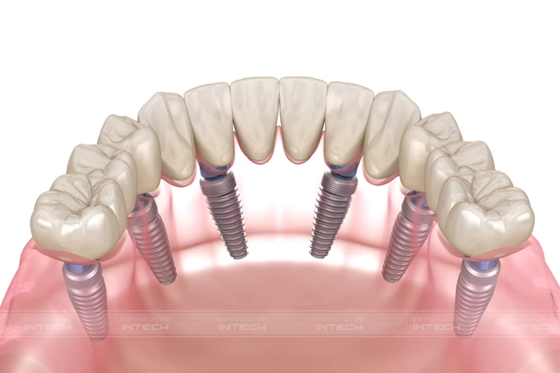 Kỹ thuật trồng răng Implant All-On-6 sử dụng 6 trụ Implant để nâng đỡ một hàm giả