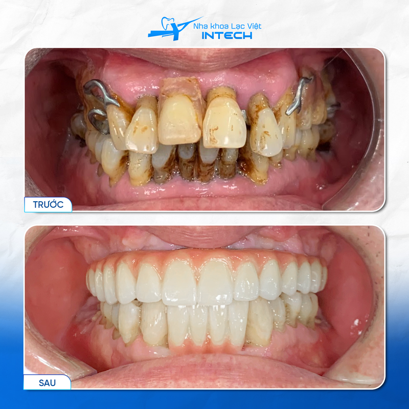 Người có các răng lỏng lẻo, xô lệch, khó ăn nhai cũng có thể trồng Implant toàn hàm All-On-6 để cải thiện