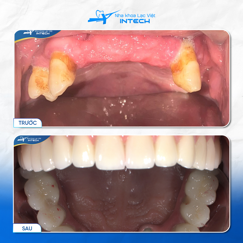 Sau khi Implant đã tích hợp hoàn toàn, bác sĩ sẽ lắp hàm giả cố định để hoàn tất điều trị