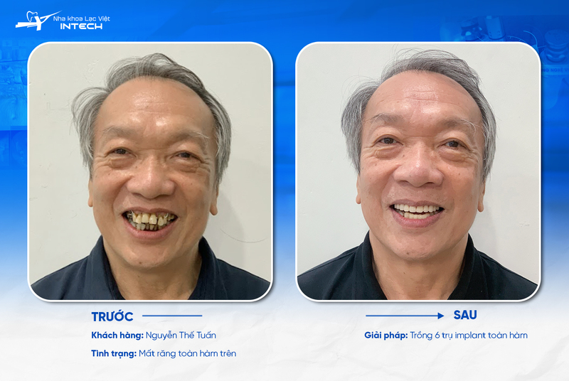 Chi phí răng Implant đơn lẻ cho người già không khác biệt so với các đối tượng khác, tùy thuộc loại vật liệu Implant mà cô chú/anh chị sử dụng