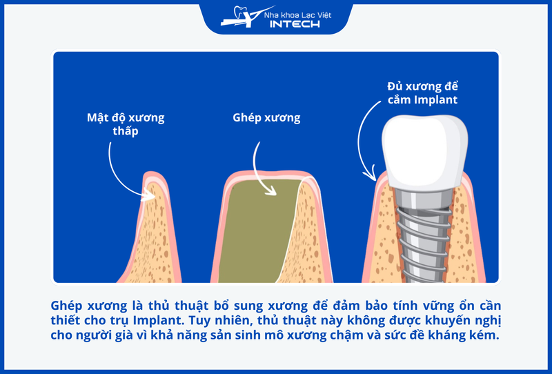 Người già thường không nên ghép xương, nâng xoang do khả năng tái tạo mô mới chậm và sức đề kháng suy giảm
