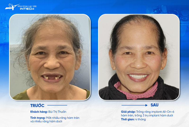 3 giải pháp trồng răng Implant cho người già an toàn, ít đau nhức