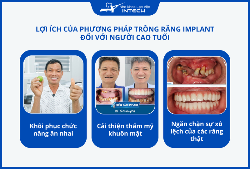 Trồng răng Implant mang lại nhiều lợi ích nổi bật cho người cao tuổi, đặc biệt là khôi phục khả năng ăn nhai và thẩm mỹ