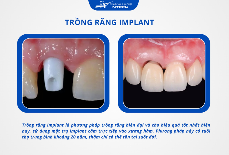 Trồng răng Implant có độ bền cao, sử dụng trụ Implant cắm trực tiếp vào xương hàm thay thế chân răng đã mất