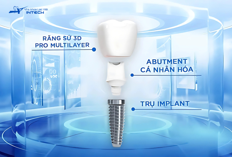 Giá cả trồng Implant phụ thuộc vào vật liệu cấy ghép và các yếu tố liên quan đến quy trình cấy ghép